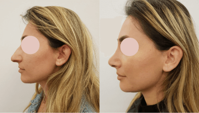 Before and after photos of a patient who underwent rhinoplasty surgery