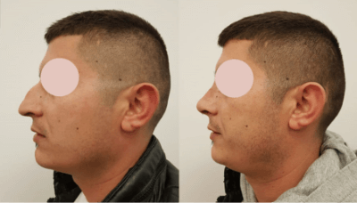 Before and after photos of a patient who underwent rhinoplasty surgery