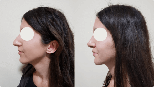 Before and after photos of a patient who underwent rhinoplasty surgery