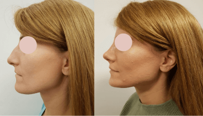 Before and after photos of a patient who underwent rhinoplasty surgery