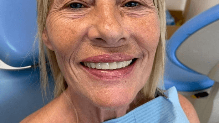 Trasformazione del sorriso di una paziente donna con servizi dentali