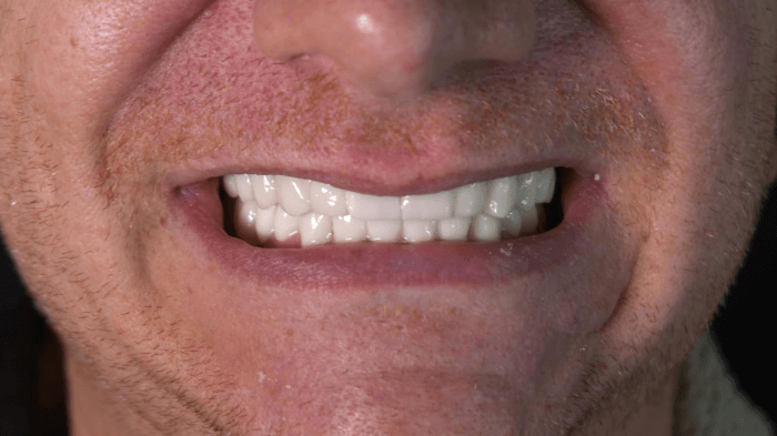 Trasformazione del sorriso di un paziente uomo con servizi dentali