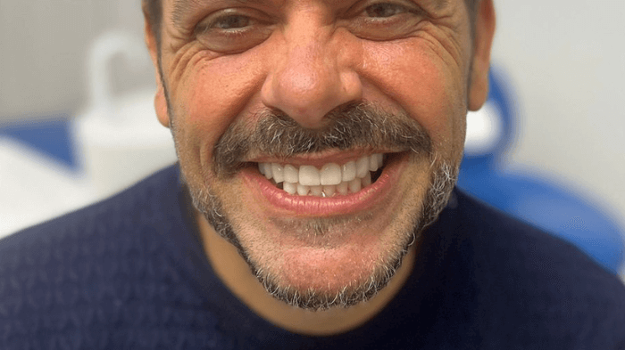 Trasformazione del sorriso di un paziente uomo con servizi dentali