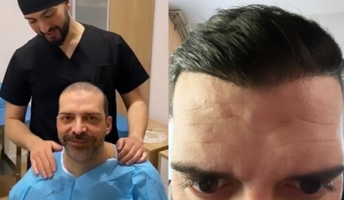 Trasformazione del capelli di un paziente uomo con trapianto capelli