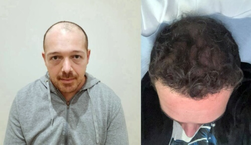 Trasformazione del capelli di un paziente uomo con trapianto capelli