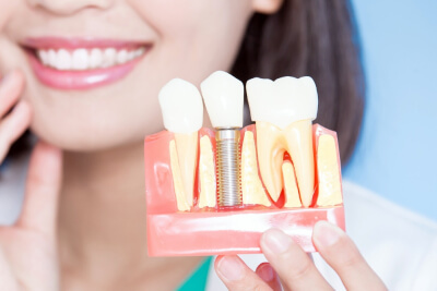 Come prepararsi per l'intervento di implantologia dentale: Consigli e raccomandazioni