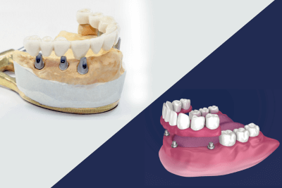 All-on-6 vs All-on-4 Dental Implants: Which One Is Right for You?