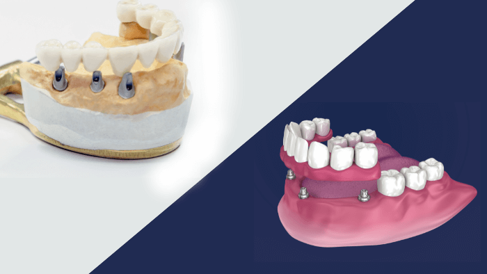 Impianti dentali All-on-6 vs All-on-4 alt
