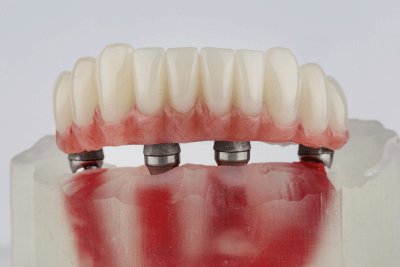 How Long Do All-on-4 Implants Last? A Practical Guide to Making Them Last a Lifetime