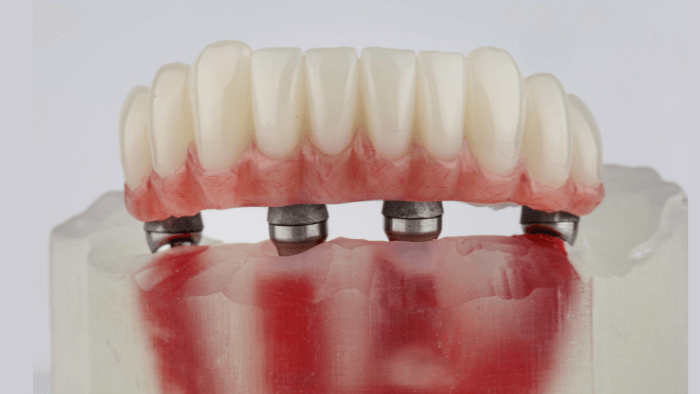 impianti All-on-4 alt
