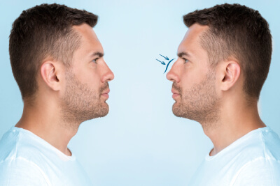 Rhinoplasty prices in Albania: Exploring costs compared to Italy