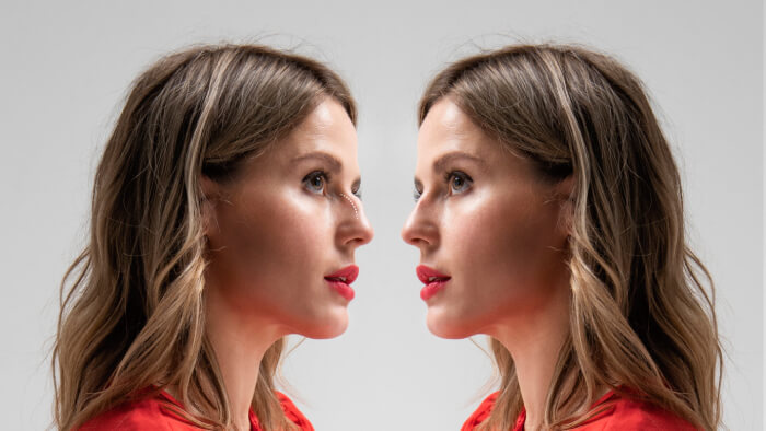 Young woman before and after rhinoplasty side view