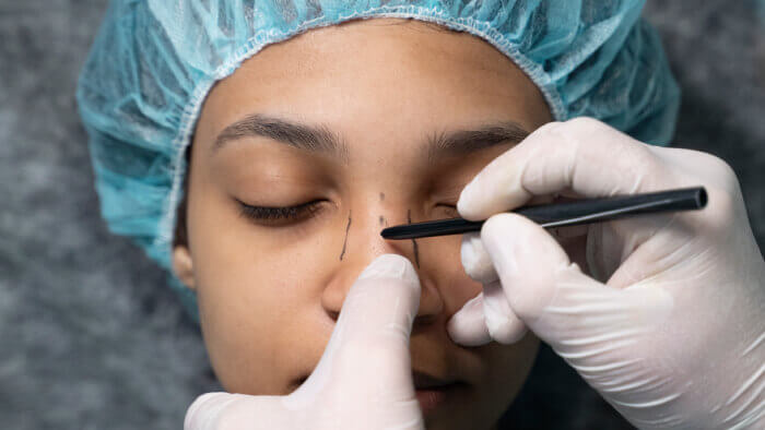 A doctor drawing with a marker before rhinoplasty surgery