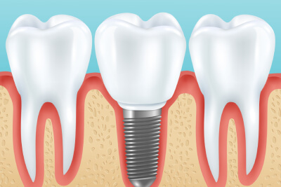 Assistenza post-trapianto dentale: Massimizzare la longevità dei tuoi impianti dentali