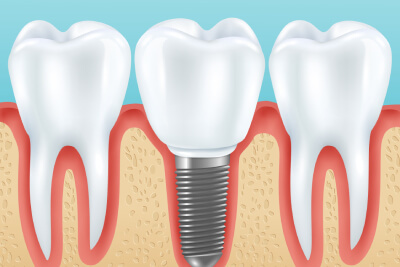 Dental implant aftercare: Maximizing the longevity of your dental implants