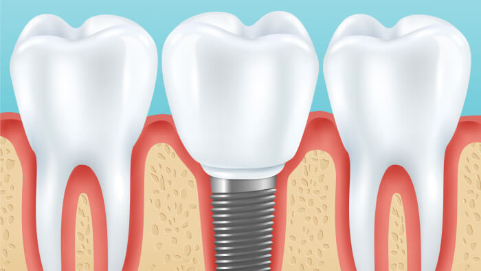 Dental implant with healthy teeth