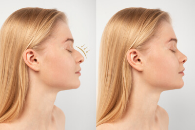 Rhinoplasty: A journey towards enhanced facial harmony