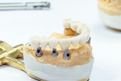 Comprendere la procedura di implantologia dentale All-On-6 passo dopo passo