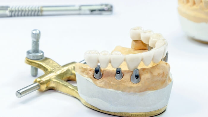 Photo of a dental implant