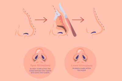 Understanding common terminology for rhinoplasty