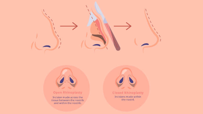 Common rhinoplasty terminology