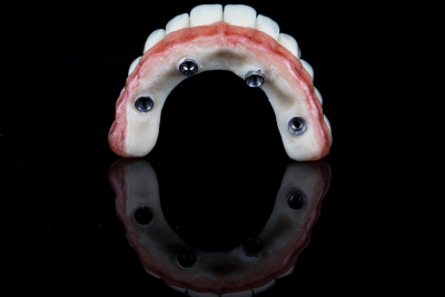 Una guida completa alla rivoluzione del rinnovamento dentale con All-on-4