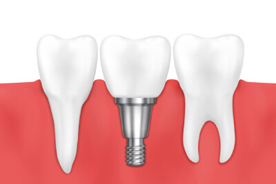 I 10 Migliori Materiali per Impianti Dentali: Pro e Contro