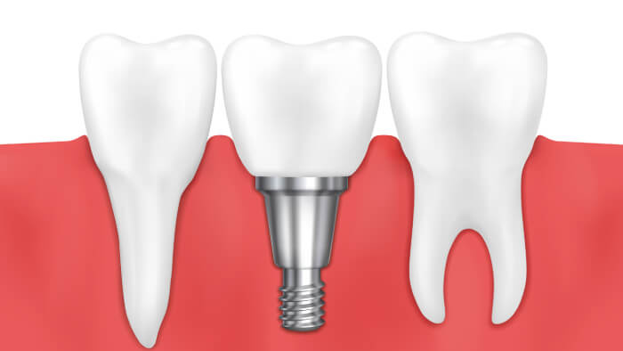 Impianto dentale dente normale