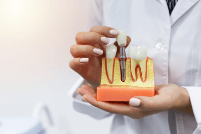 How Long Do Dental Implants Last? Are They Forever?