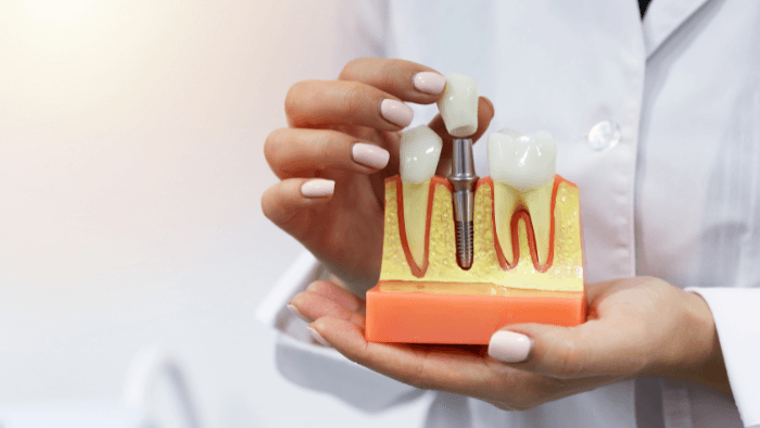 dental implant alt