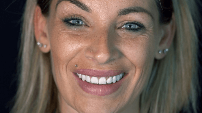 Trasformazione del sorriso di una paziente donna con impianti dentali