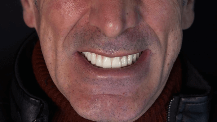 Trasformazione del sorriso di un paziente uomo con impianti dentali