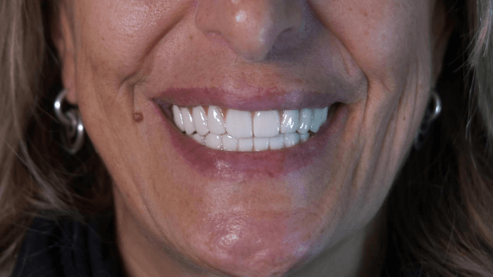 Trasformazione del sorriso di una paziente donna con impianti dentali