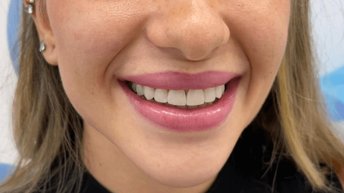 Trasformazione del sorriso di una paziente donna con impianti dentali