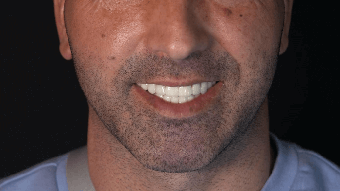 Trasformazione del sorriso di un paziente uomo con impianti dentali