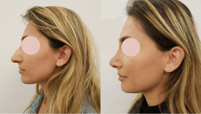 Photos avant et après d’un patient ayant subi une opération de rhinoplastie