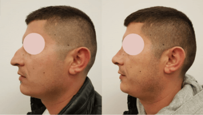 Photos avant et après d’un patient ayant subi une opération de rhinoplastie
