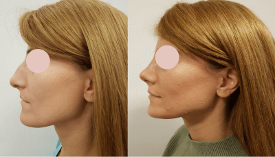 Photos avant et après d’un patient ayant subi une opération de rhinoplastie