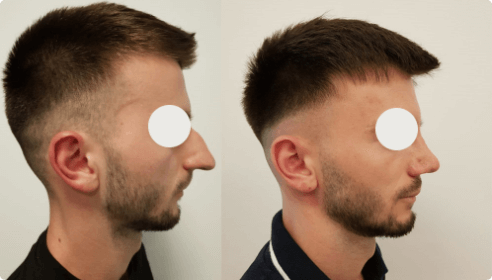 Photos avant et après d’un patient ayant subi une opération de rhinoplastie