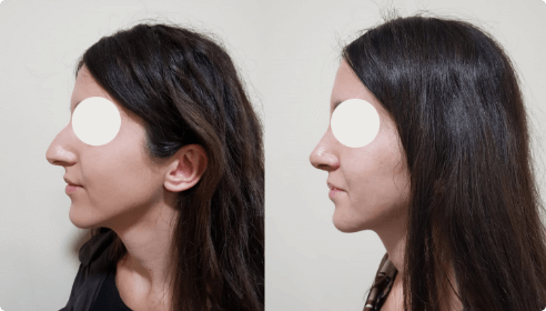 Photos avant et après d’un patient ayant subi une opération de rhinoplastie