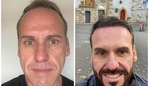Woman Patient Hair Transformation with Hair transplants