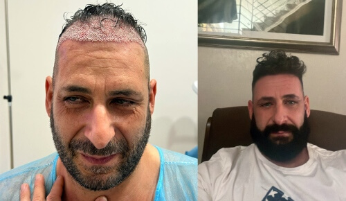 Woman Patient Hair Transformation with Hair transplants