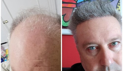 Man Patient Hair Transformation with Hair transplants