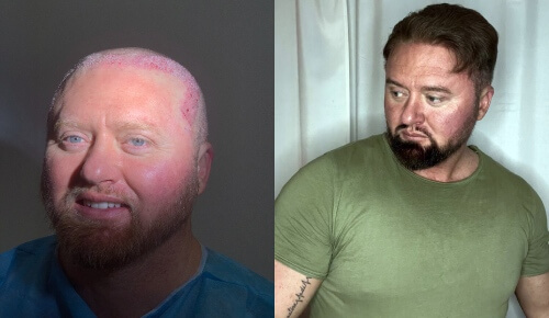 Woman Patient Hair Transformation with Hair transplants