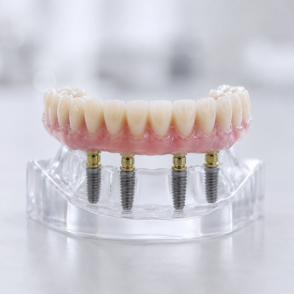 Paziente sorridente dopo un percorso di implantologia dentale a Tirana
