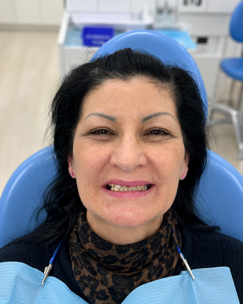 Denti del paziente prima della procedura con impianti dentali