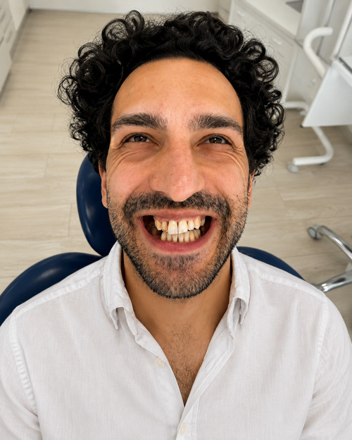 Denti del paziente prima della procedura con impianti dentali