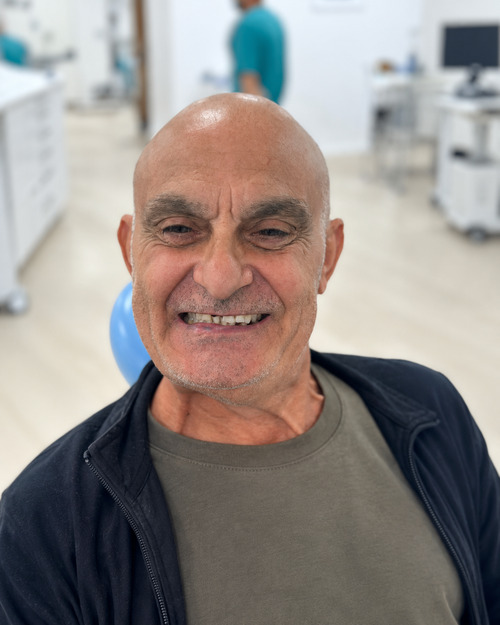 Denti del paziente prima della procedura con impianti dentali