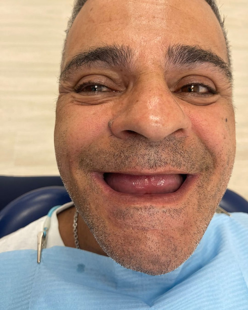 Denti del paziente prima della procedura con impianti dentali