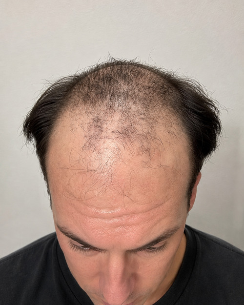 Foto del paziente prima del trapianto di capelli